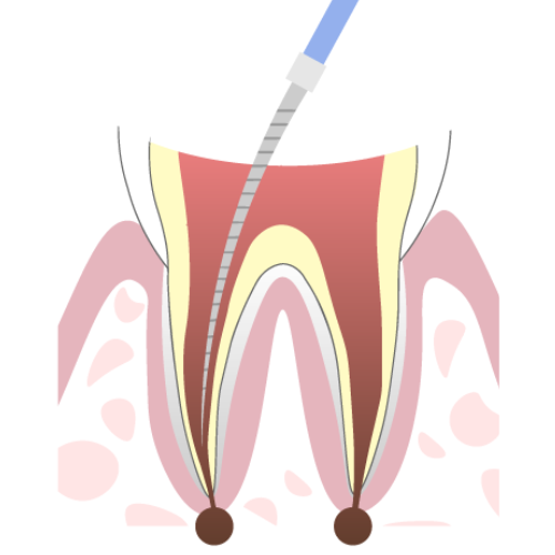 仙台ひとみ歯科根っこの治療
